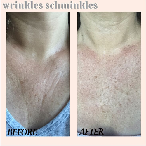 Wrinkles Schminkles Chest Smoothing Kit